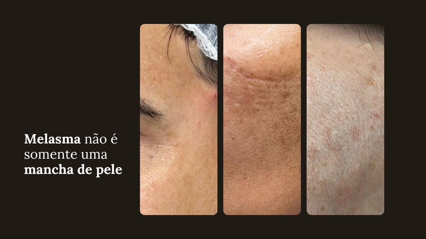 melasma